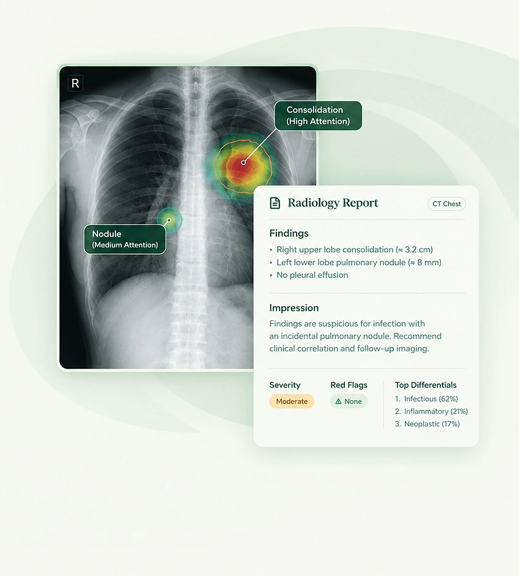 A chest radiograph with two highlighted regions, one marked consolidation at high attention and one marked nodule at medium attention, beside a structured radiology report listing findings, impression, severity, red flags and ranked differentials.